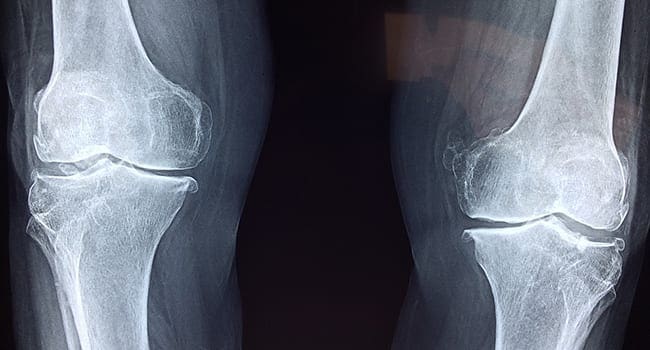 Why most knee injuries don’t need surgery to heal